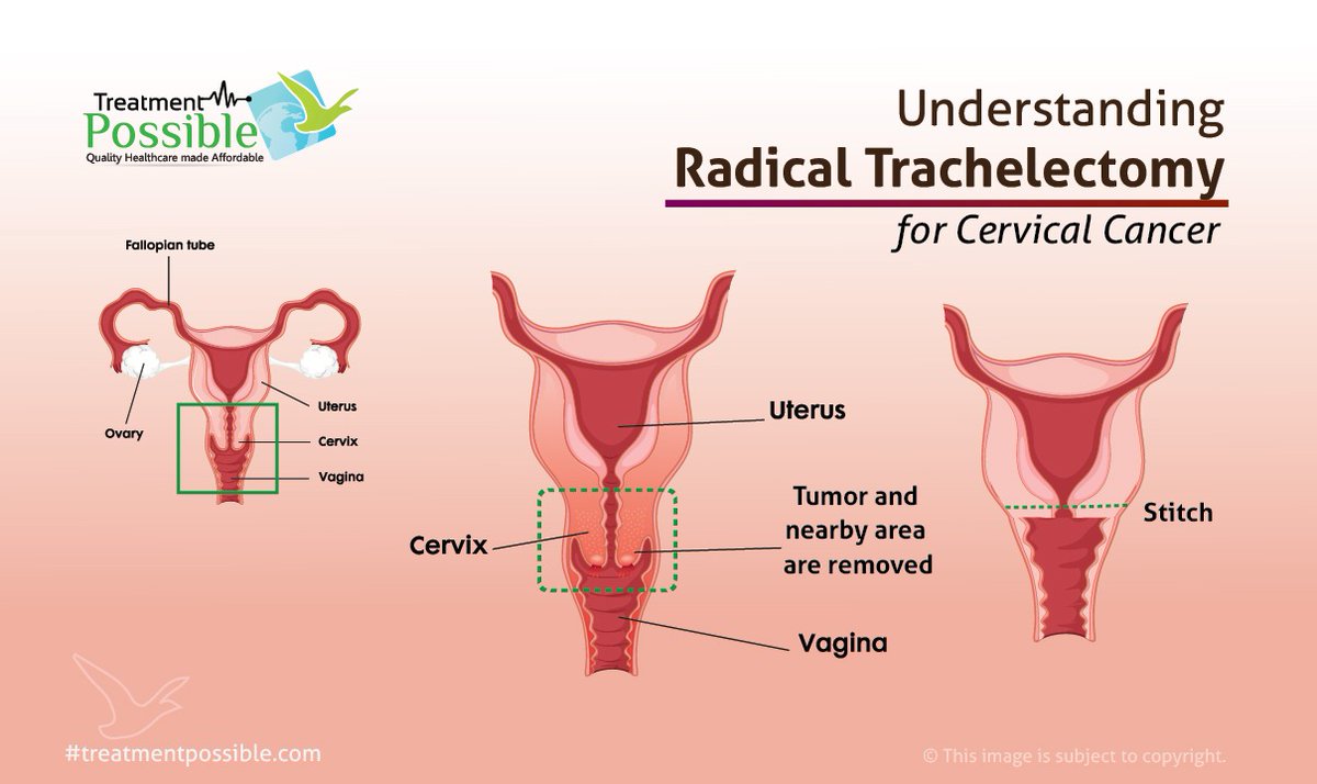 ciri-ciri kanker serviks 12 Ciri-Ciri Kanker Serviks Telah Menyerang Tubuh Anda
