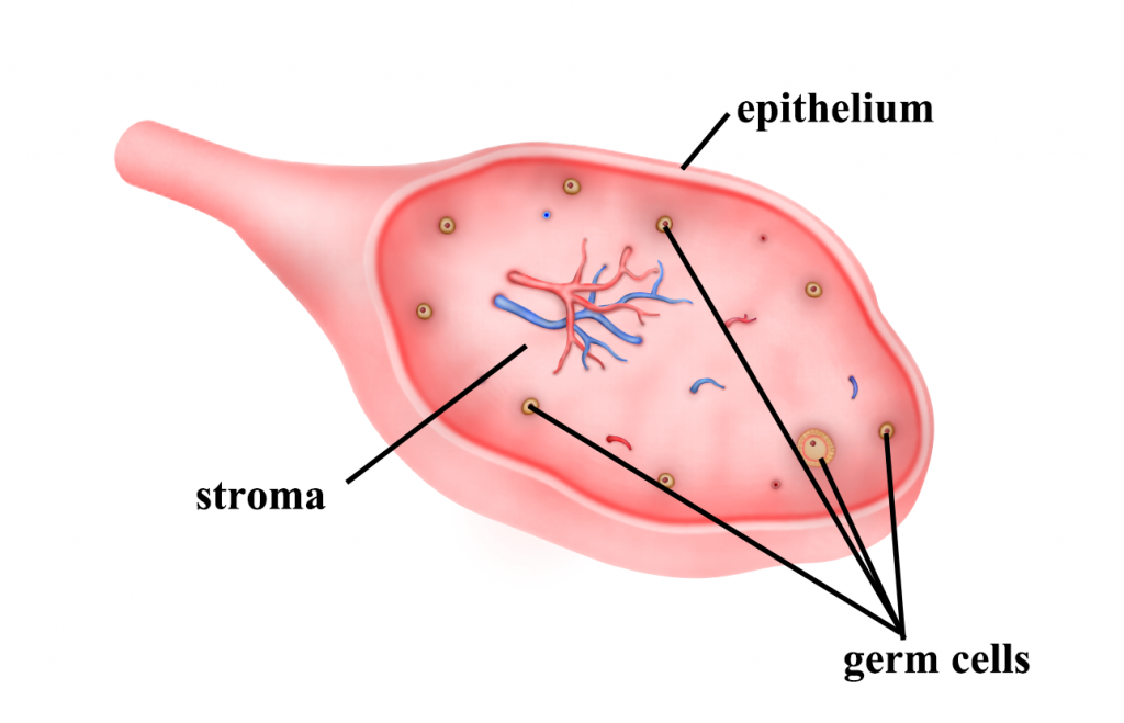 kanker ovarium