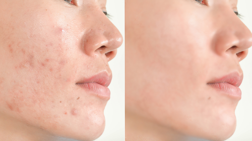 kebaikan kunir asem kebaikan kunir asem