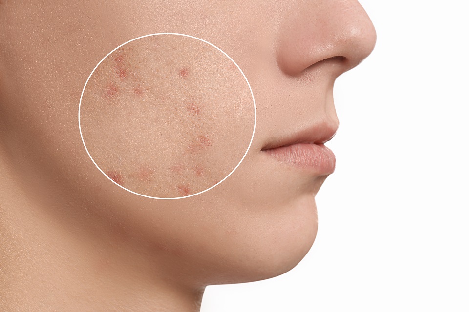 Manfaat kismis hitam untuk kecantikan