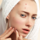 5 Things to Know About Collagen Drinks for Acne Skin