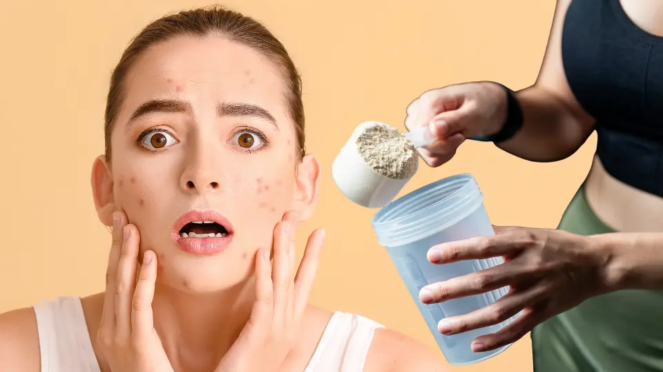 acne and whey protein cause